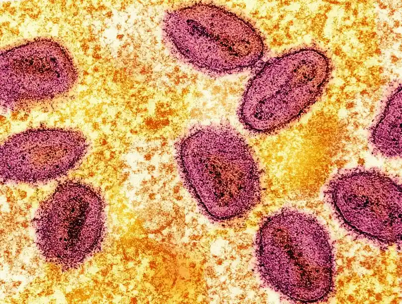 New Mpox Variant Detected in England as Health Officials Step Up Monitoring second image